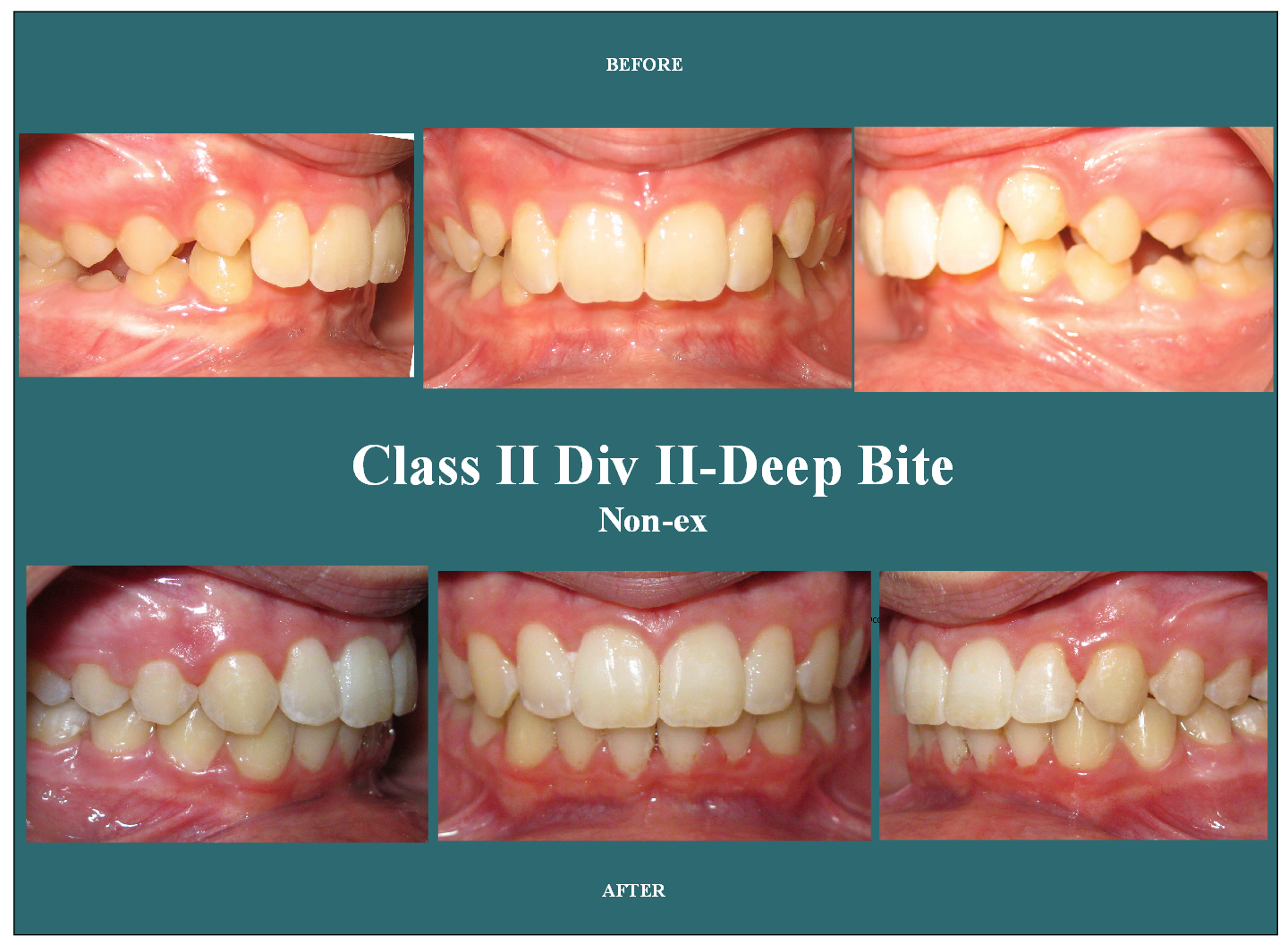 Before and After Orthodontist Chandler Gilbert Phoenix AZ Sonoran