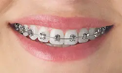 Does Everyone Who Wears Braces Need Elastics? - Soleil Orthodontics